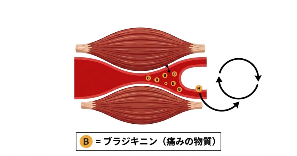 血管圧迫により痛みの物質ブラジキニンが発生し循環するメカニズムの図解