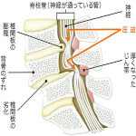 腰部脊柱管狭窄症のイメージ