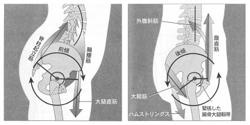 骨盤周りの筋拘縮による姿勢への影響